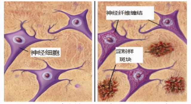 阿尔茨海默症的五个真相，要警惕是阿尔茨海默病