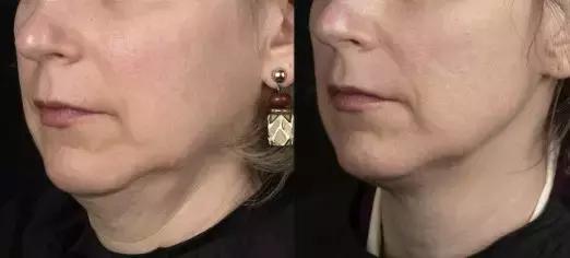 立马见效脸变小的方法，四招让你快速瘦脸