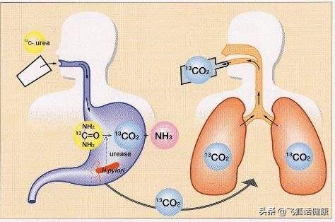 幽门螺杆菌hp值多少正常，幽门螺杆菌感染“面面观”