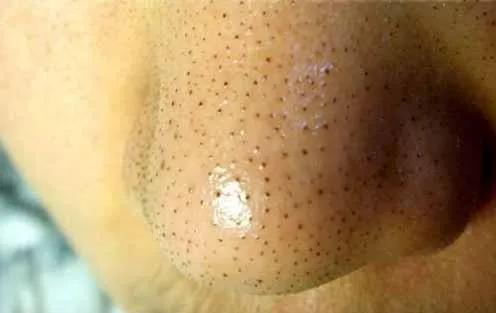 清理黑头的正确方法，黑头清理办法大全