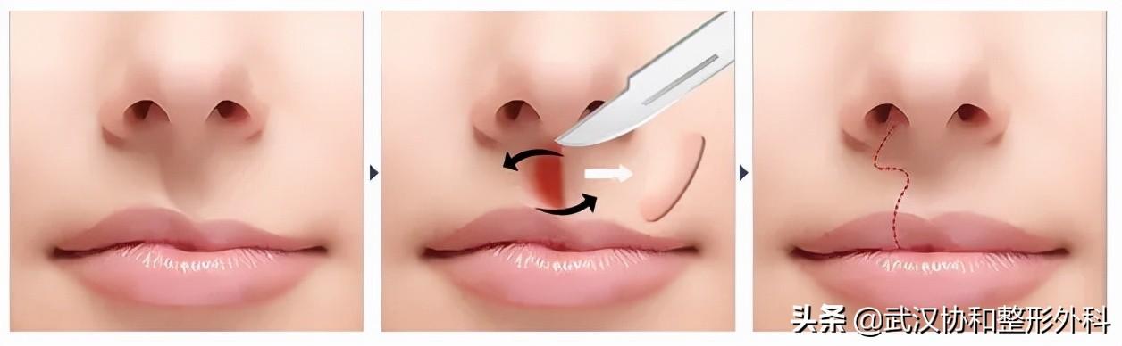 常见的唇部整形都有哪些，唇部整形有什么方法