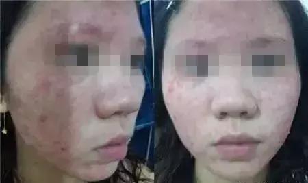 皮肤过敏用什么化妆品，抗敏修护保湿护肤品排行榜10强