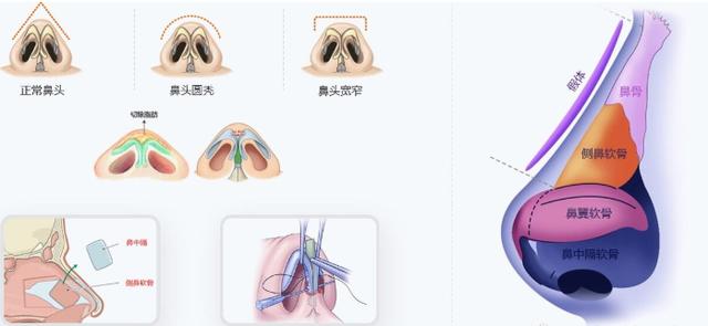 隆鼻用什么填充材料好，隆鼻填充物有哪些