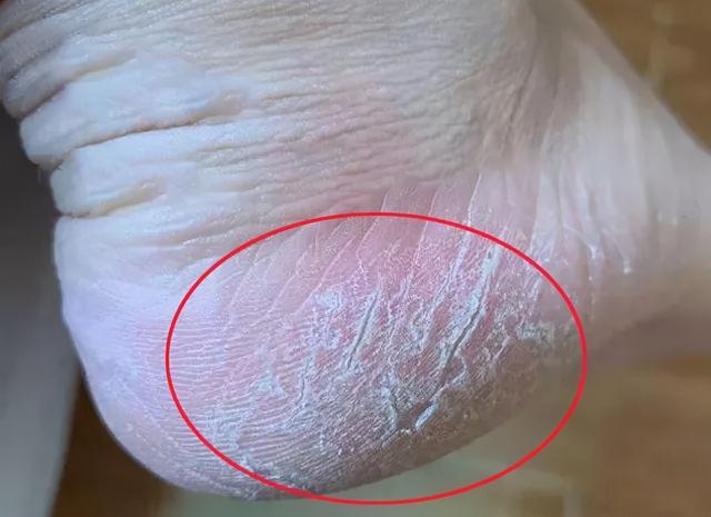 糖尿病老脱皮(糖尿病老脱皮怎么回事)