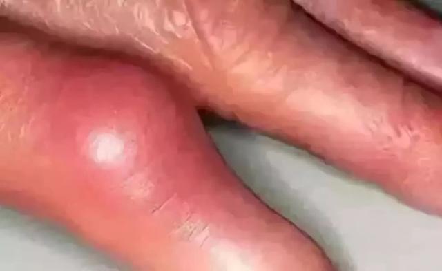 糖尿病飘零(糖尿病嘌呤)
