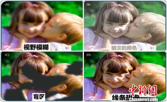 糖尿病引起的黄斑水肿(糖尿病引起的黄斑病变怎么治疗)