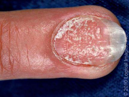 儿童指甲有一点白白的缺营养吗，小孩指甲软，跟缺钙无关