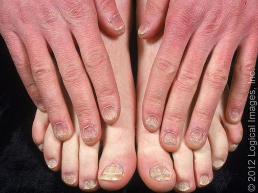 儿童指甲有一点白白的缺营养吗，小孩指甲软，跟缺钙无关