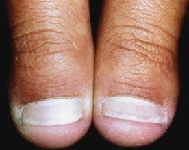 儿童指甲有一点白白的缺营养吗，小孩指甲软，跟缺钙无关