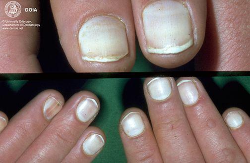 儿童指甲有一点白白的缺营养吗，小孩指甲软，跟缺钙无关