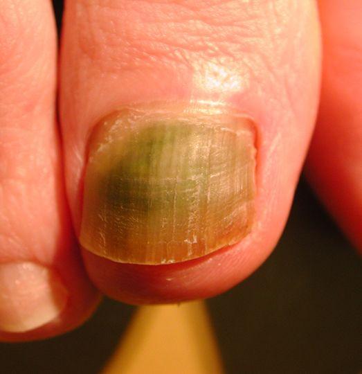 儿童指甲有一点白白的缺营养吗，小孩指甲软，跟缺钙无关