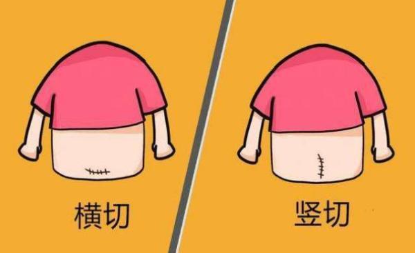 肥胖孕妇竖刨(肥胖孕妇适合顺产还是剖腹产)