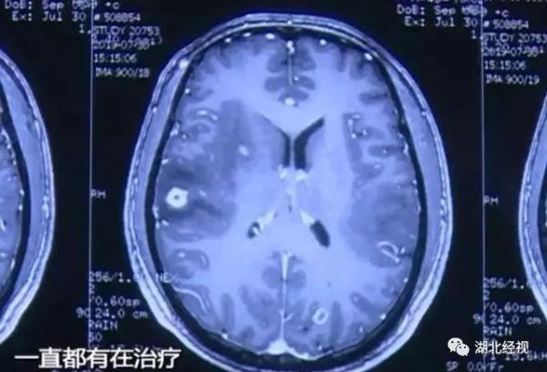 猪血生吃会伤身体吗，男子生吃猪血30年