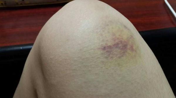 腿伤了糖尿病(糖尿病人腿受伤伤口不愈合)