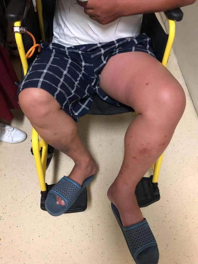 大腿突然肥胖(最近大腿胖很快)