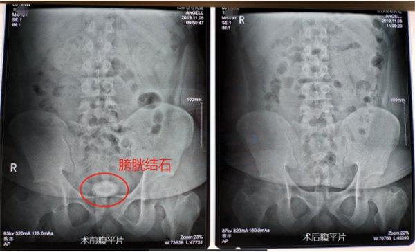 肥胖跟膀胱(肥胖会引起膀胱炎吗)