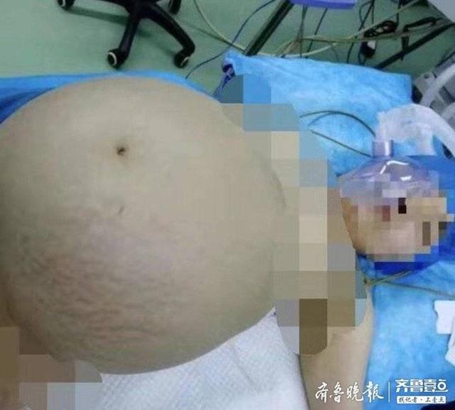未婚肥胖纹(肥胖纹让我自卑)