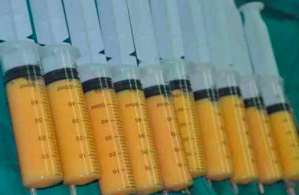 腋臭手术伤口处起水泡(腋臭手术伤口处有个疙瘩)
