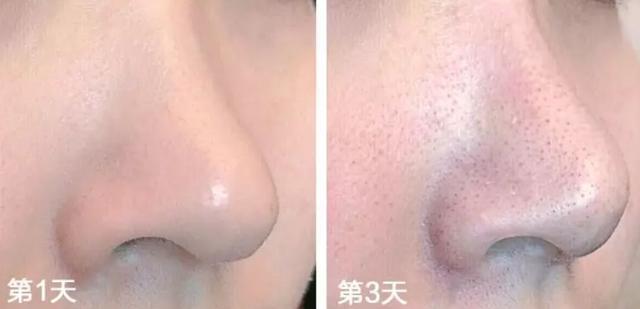 去黑头的最温和科学方法，10年老黑头都能干净