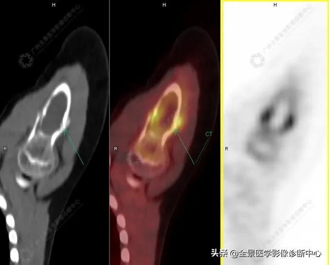 骨囊肿早期图片，骨囊肿是怎么消除（骨囊肿的发病原因仍不知）