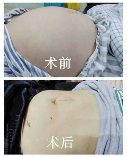 手术切除肥胖纹(肥胖纹手术后还会再出来吗)