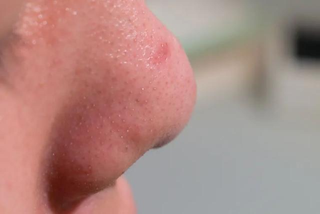 去黑头的最温和科学方法，10年老黑头都能干净