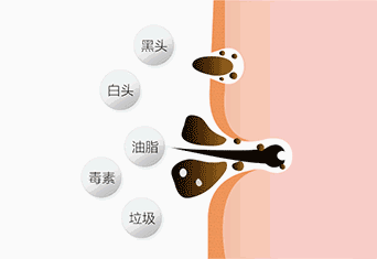 去黑头的最温和科学方法，10年老黑头都能干净