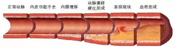 糖尿病会晕厥吗(糖尿病会晕厥吗为什么)