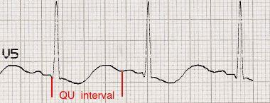 qtc间期正常值，心电图qt和qtc间期正常是多少毫秒