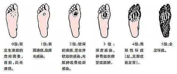 糖尿病坏疽足(糖尿病型足坏疽)