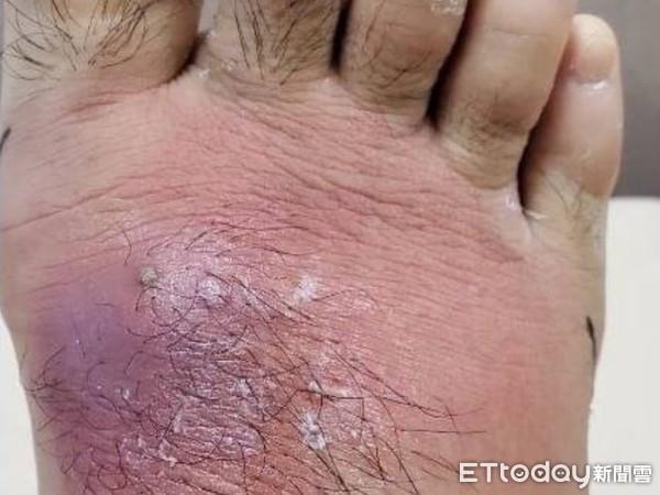 蜂窝性肥胖(蜂窝组织肥胖什么原因)