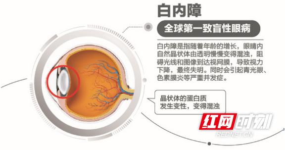 糖尿病引发的白内障(糖尿病引发的白内障怎么治疗)