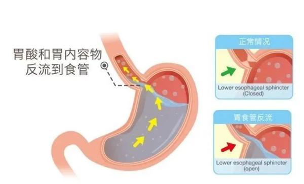 肥胖反流性(反流临床表现)