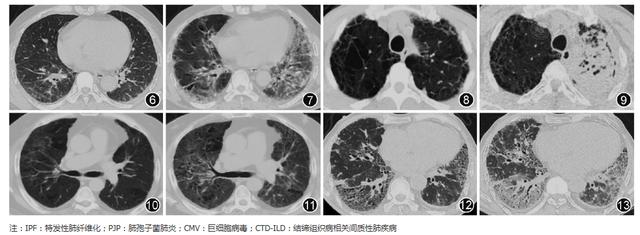 注:ipf:特发性肺纤维化;pjp:肺胞子菌肺炎;cmv:巨细胞病毒;ctd-ild