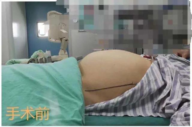 囊肥胖