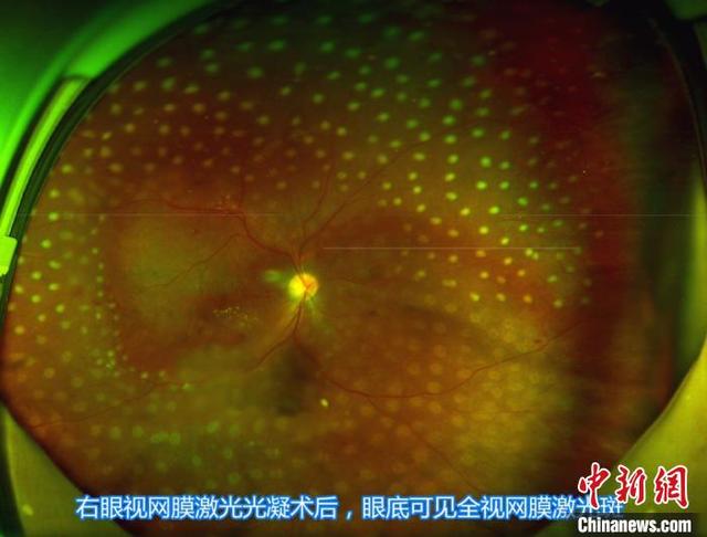 糖尿病视力突然下降(糖尿病视力突然变好要警惕)