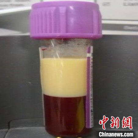 糖中毒肥胖(糖中毒是不是糖尿病)