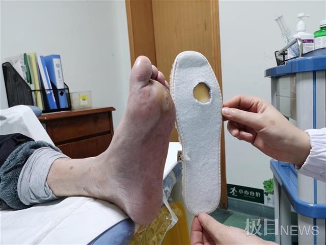 糖尿病脚针刺(糖尿病脚针刺感和其它病的区别)