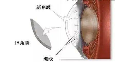 人工角膜3000和6000有什么区别，南阳南石眼科丨角膜塑形镜配戴分享