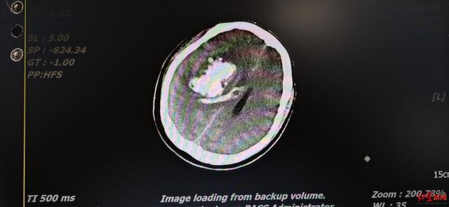 糖尿病引发的脑溢血(糖尿病引发的脑梗死能治好吗)