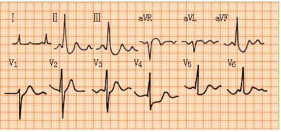 完左和完右心电图口诀，看懂心电图的十大口诀