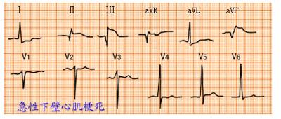 完左和完右心电图口诀，看懂心电图的十大口诀