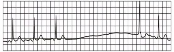 完左和完右心电图口诀，看懂心电图的十大口诀