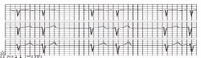 完左和完右心电图口诀，看懂心电图的十大口诀
