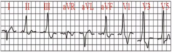 完左和完右心电图口诀，看懂心电图的十大口诀