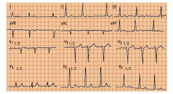 完左和完右心电图口诀，看懂心电图的十大口诀