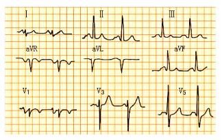 完左和完右心电图口诀，看懂心电图的十大口诀
