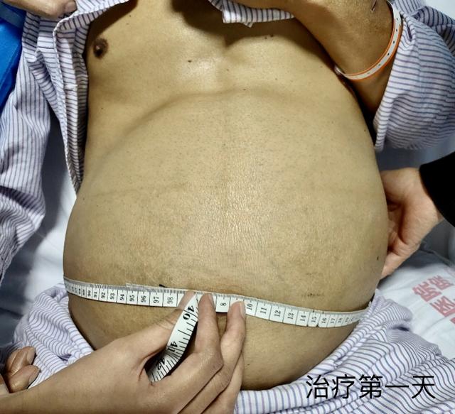 心膜肥胖(心膜扩大是什么病)