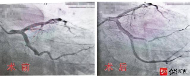 肥胖心肌梗塞(肥胖心肌梗塞能活多久)