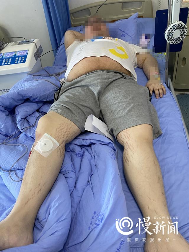 肥胖纹和紫纹(肥胖纹发紫)